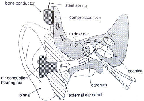 Beispiel zur Körperschallübertragung anhand von Hörgeräten